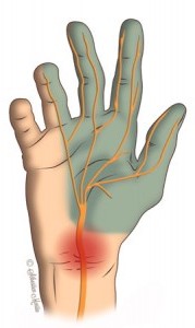 Carpal Tunnel Syndrome - Raleigh Hand Surgery — Joseph J