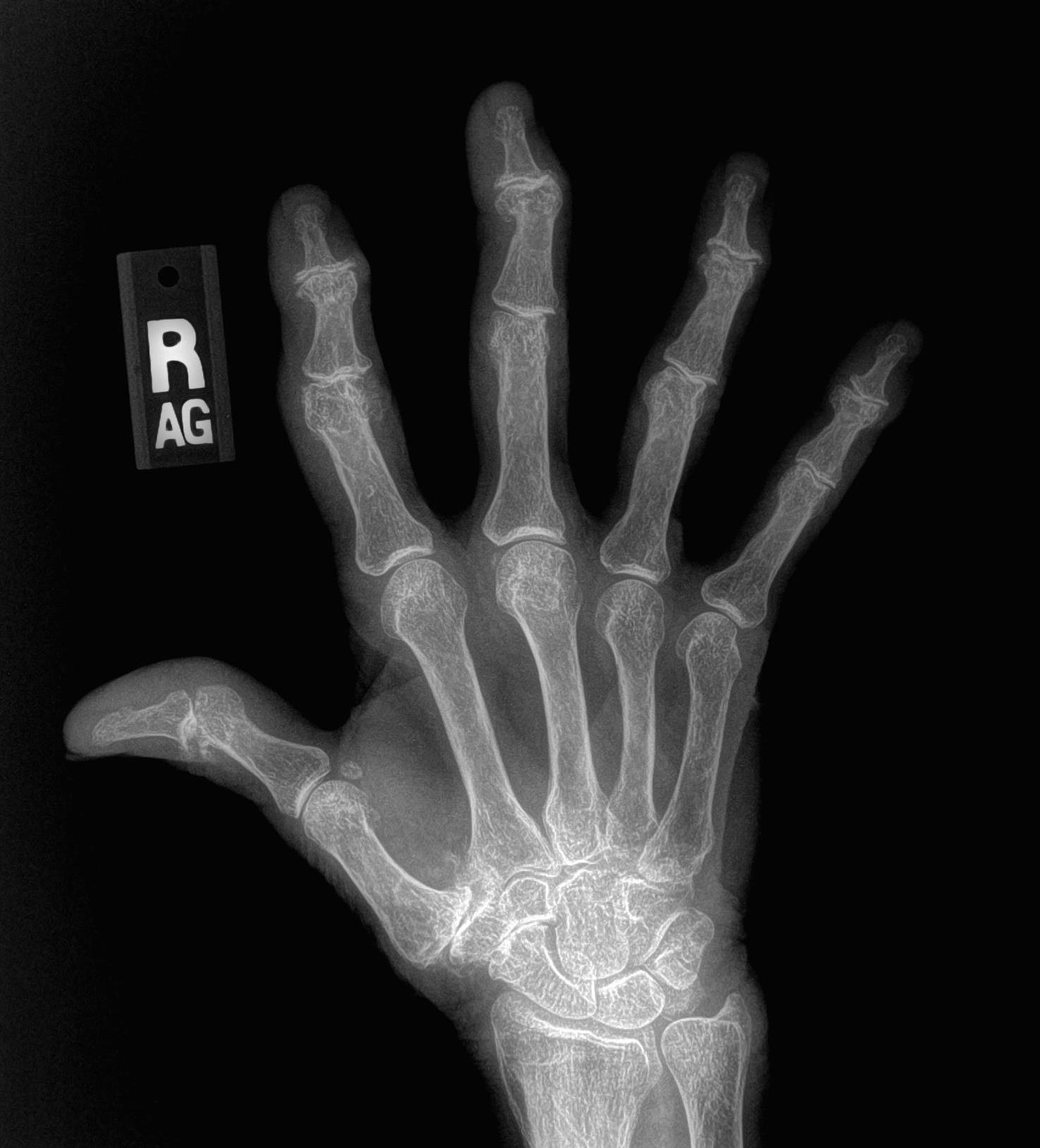 Артрит лучезапястного сустава рентген