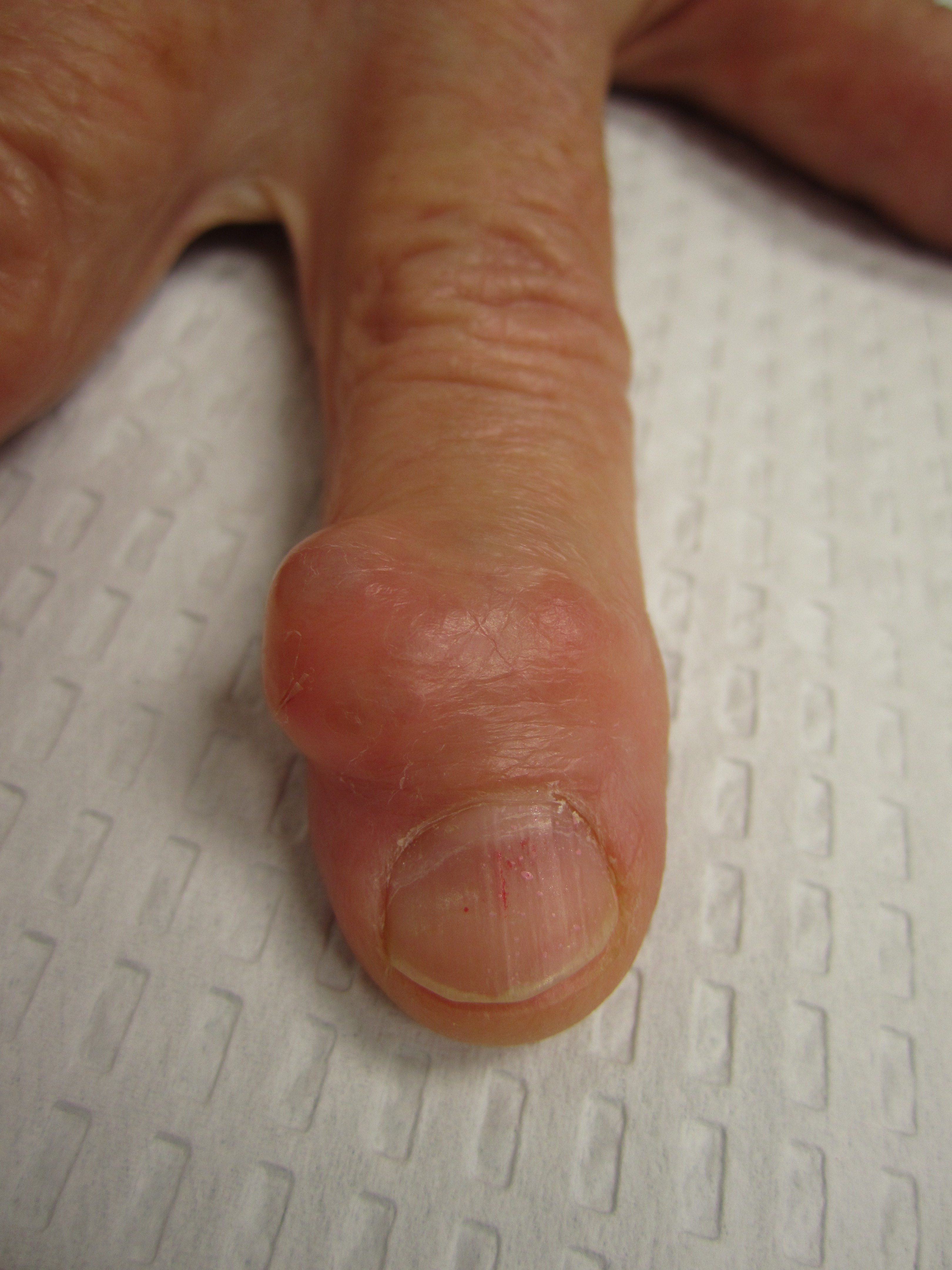 Photos Of Mucous Cysts In Fingers John Erickson MD