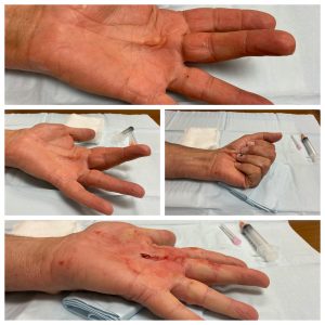 Nonsurgical Treatment Dupuytrens Contracture