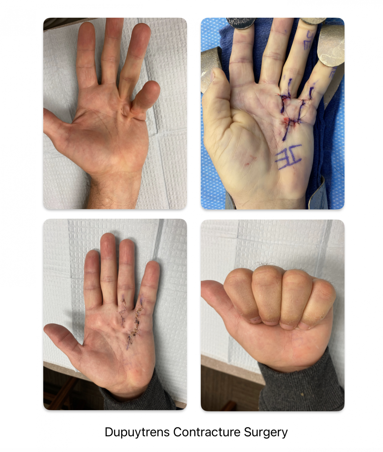 Scar Tissue Dupuytren Contracture Surgery