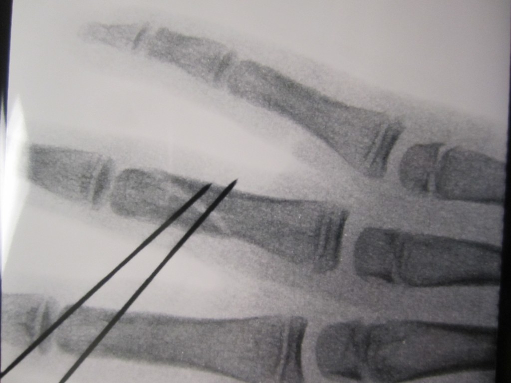 Less Invasive Finger Fracture Treatment John Erickson Md