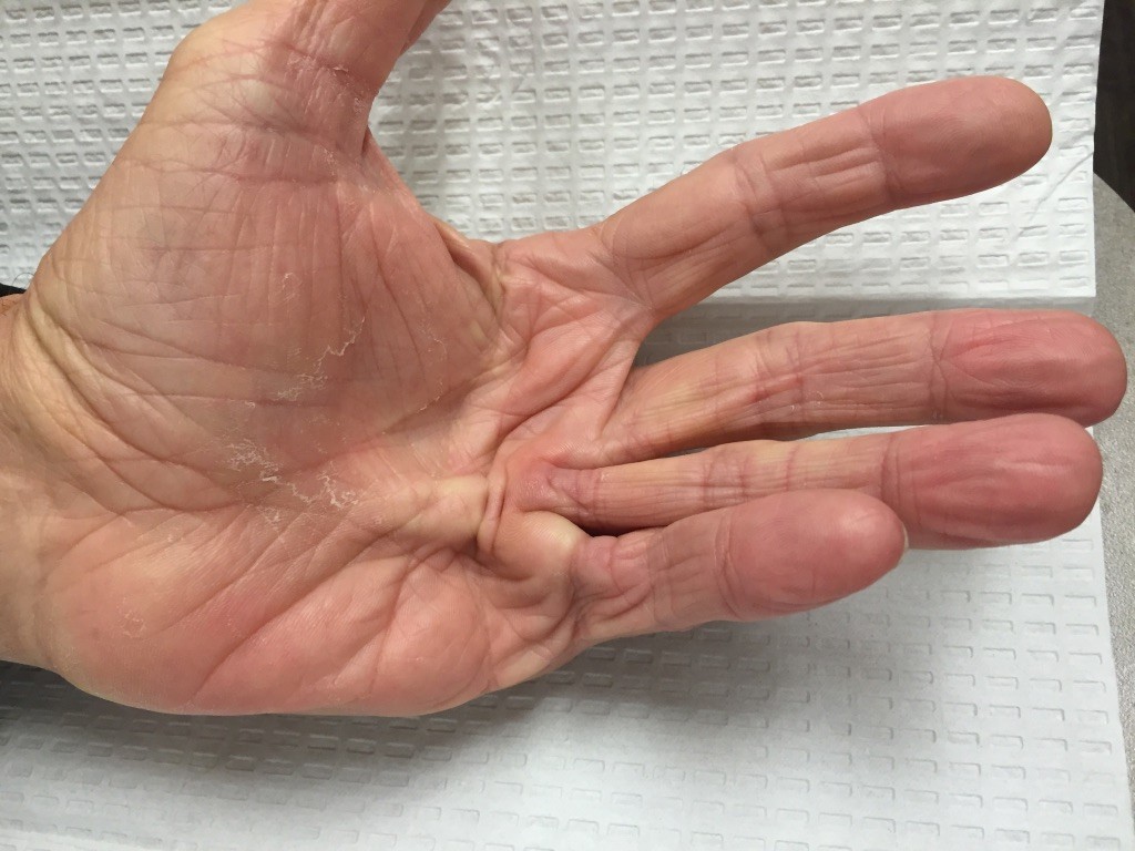 Dupuytrenscontracture 1024x768 