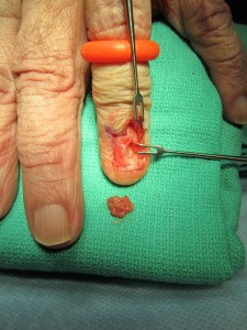 Lumps, Bumps, and Cysts in the Hand - John Erickson, MD