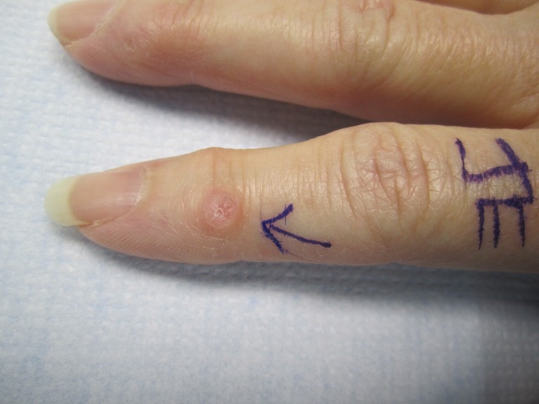 warm compress for cyst on finger