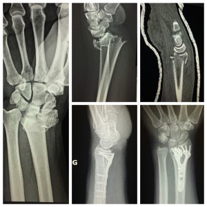 need surgery for broken wrist