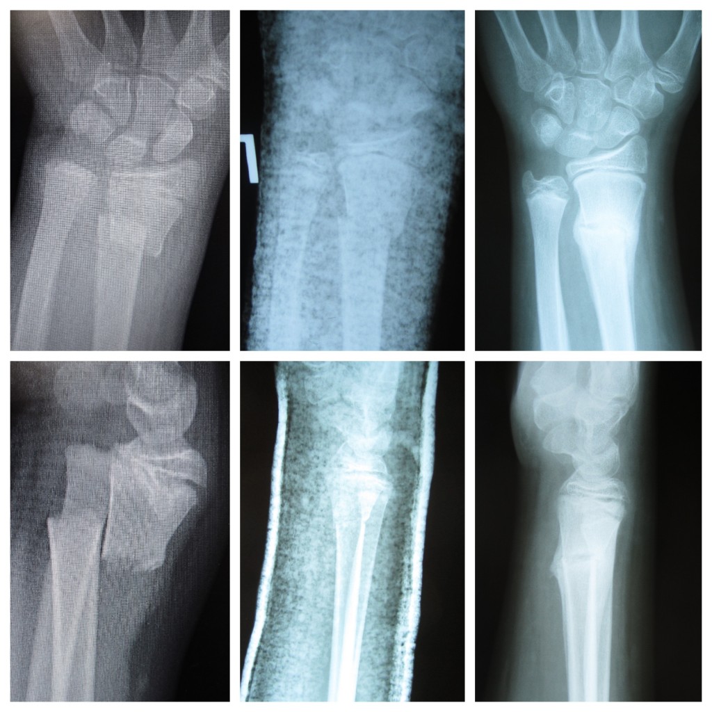 Pediatric Distal Radius Fracture 3 John Erickson Md