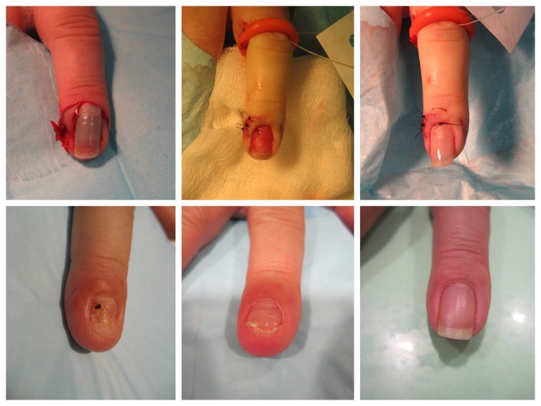 surgical-repair-of-fingernail-injury-john-erickson-md