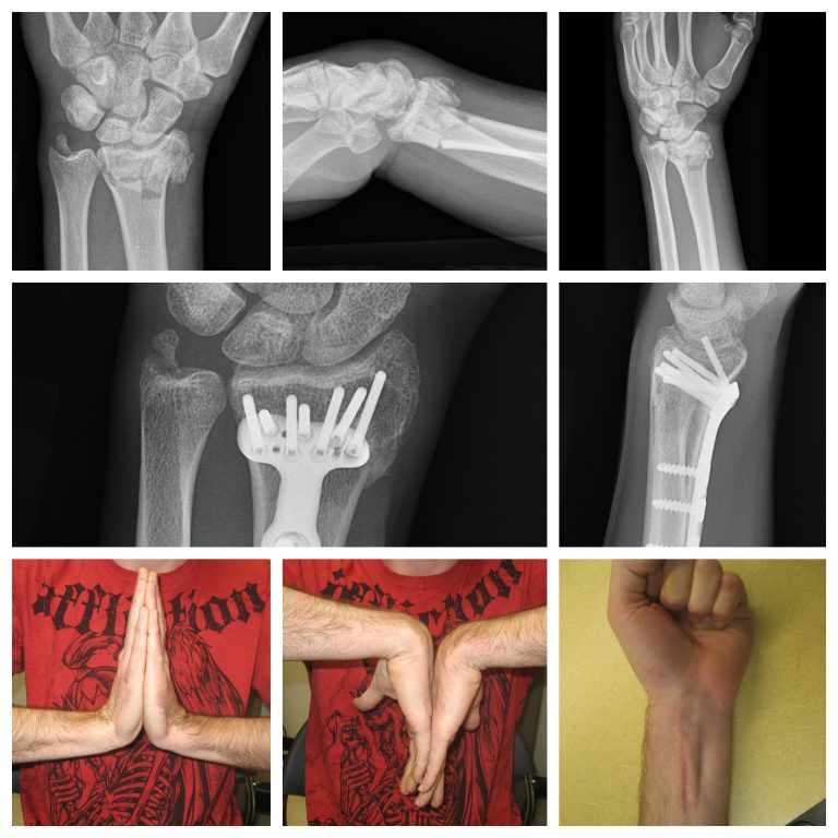 wrist distal radius fracture