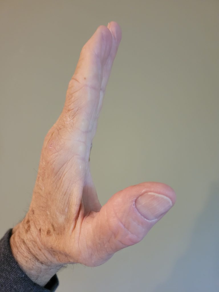 Dupuytren Contracture
